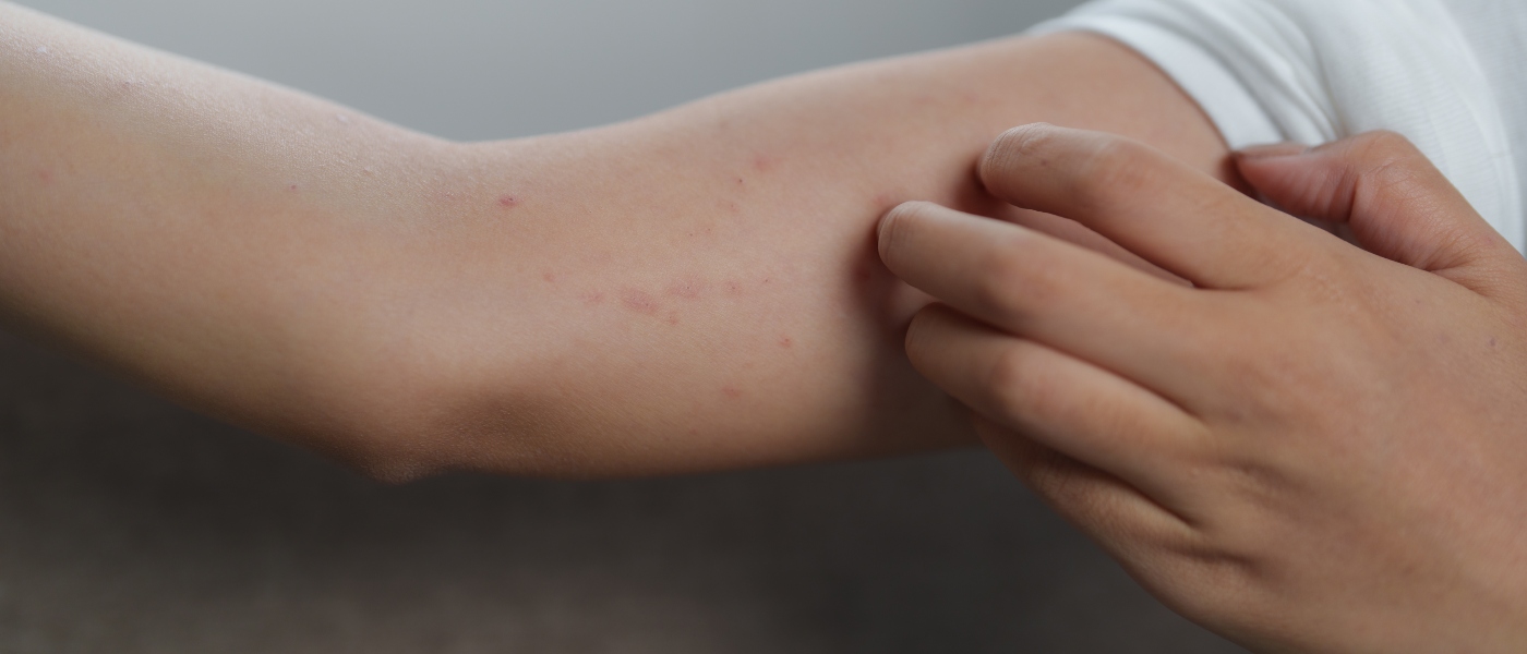 Eccemas, psoriasis y... estrés: el reto clínico de abordar las dermatosis desde lo biopsicosocial